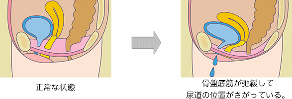 図解尿漏れ